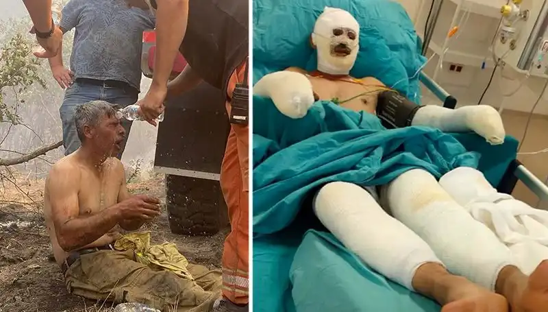 Yanıyorum Diye Feryat Eden Orman İşçisi Hayata Dönmeye Çalışıyor
