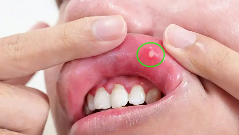 B Vitamini Eksikliği Belirtileri: Hangi İşaretlere Dikkat Etmeliyiz?