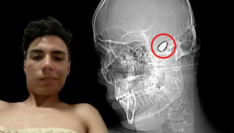 Kafasında Patlayıcı Var: Bu Genç Adamın Şok Edici Hikayesi